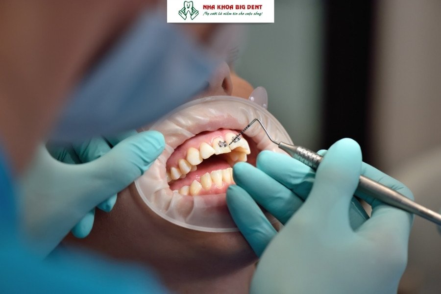 niềng răng lệch lạc