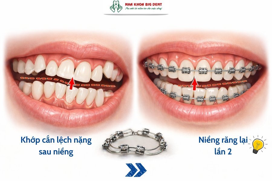 niềng răng xong vẫn xấu