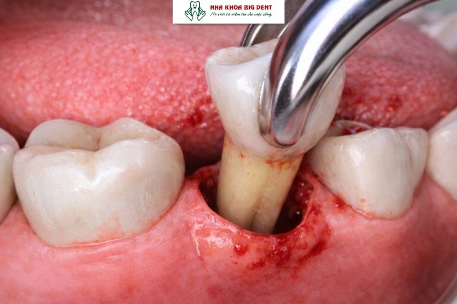 niềng răng giai đoạn nào đau nhất