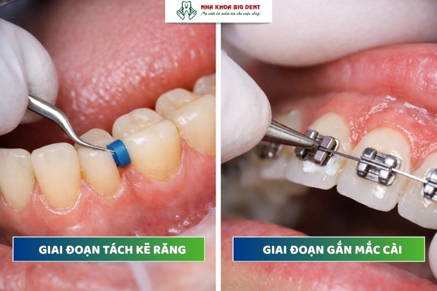 niềng răng giai đoạn nào đau nhất