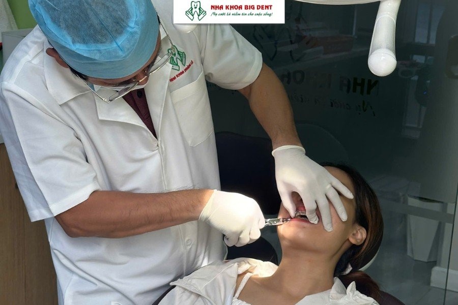 quy trình niềng răng khớp cắn sâu