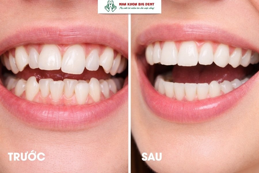 niềng răng lệch lạc