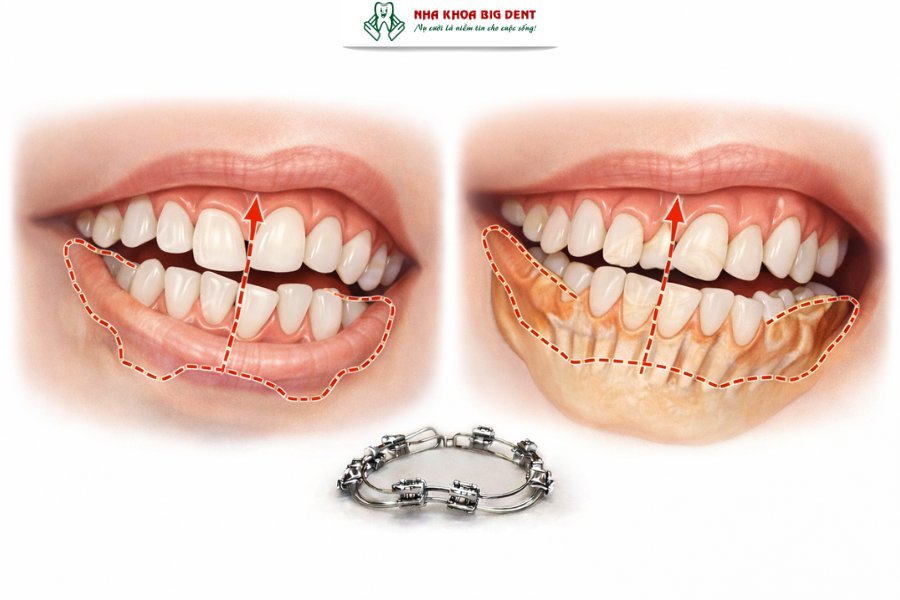 niềng răng xong vẫn xấu