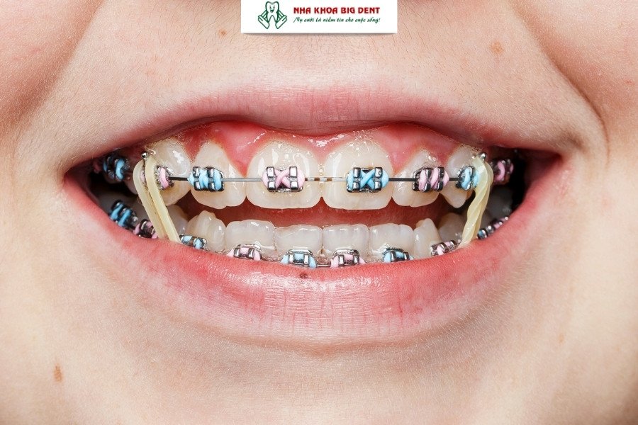 niềng răng mắc cài kim loại