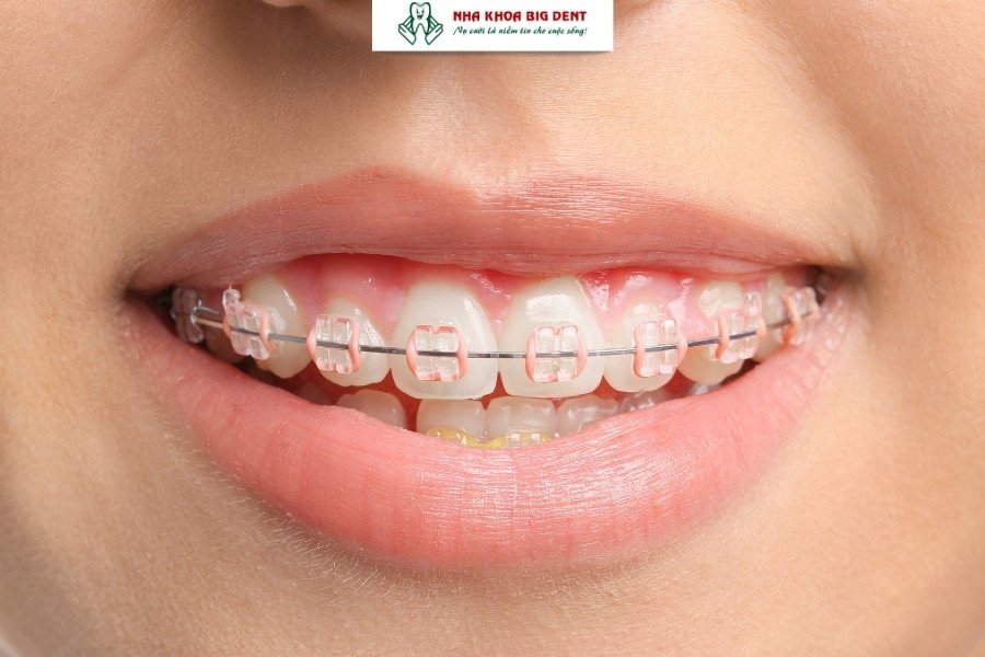 niềng răng mắc cài sứ