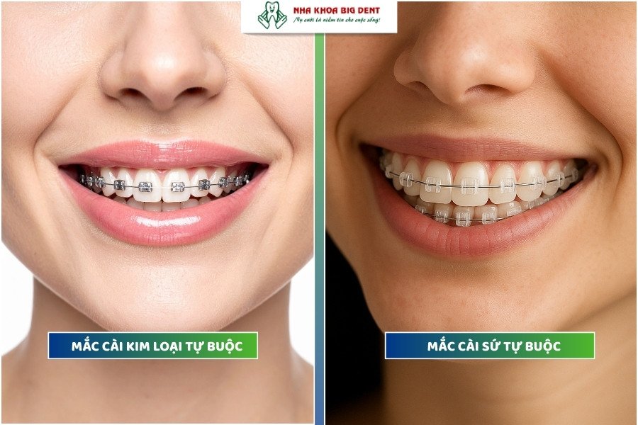 niềng răng mắc cài tự buộc