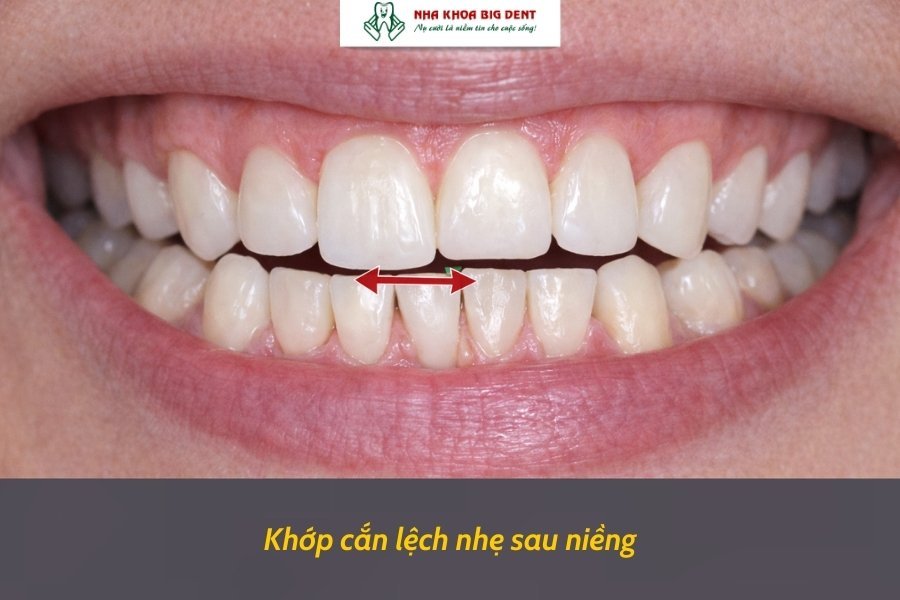 khớp cắn lệch nhẹ