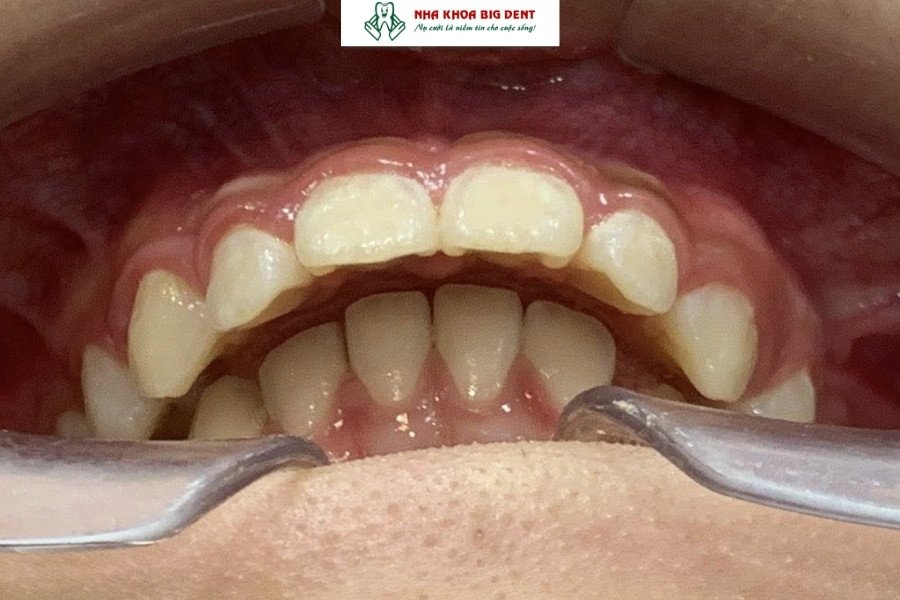 Tình trạng khớp cắn sâu