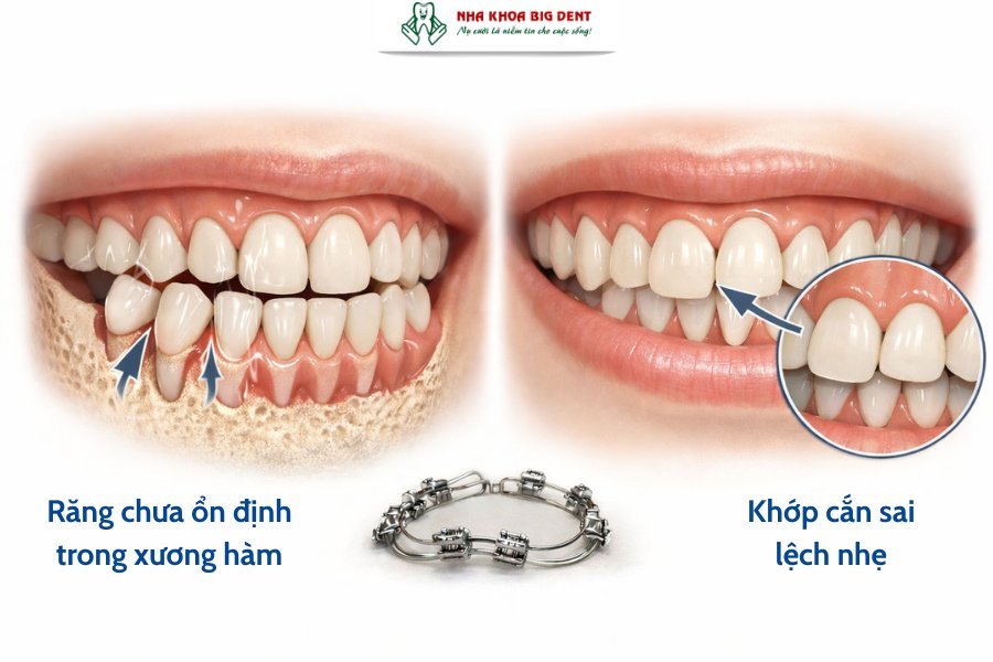 niềng răng xong vẫn xấu