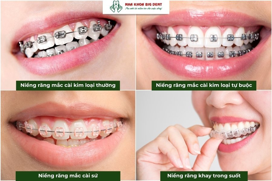 phương pháp niềng răng