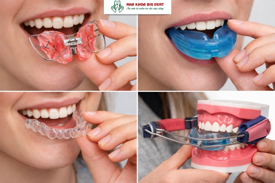 niềng răng tháo lắp