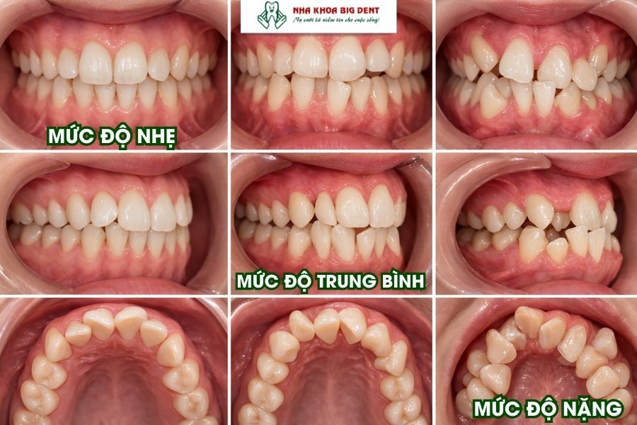 răng khấp khểnh