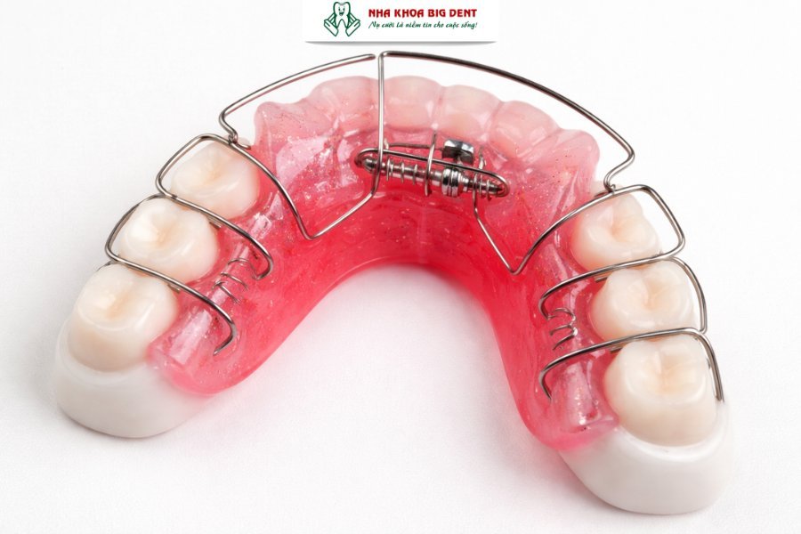 niềng răng tháo lắp