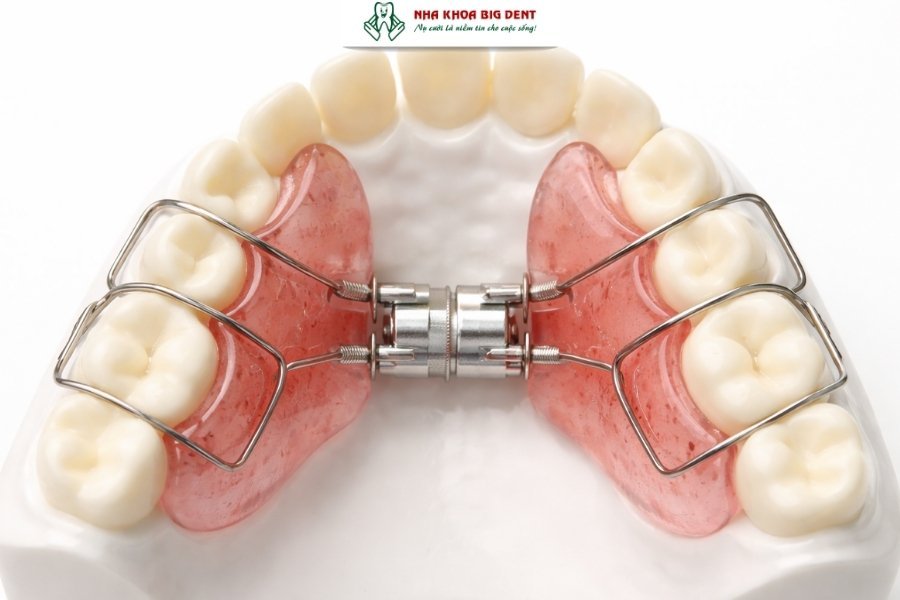 niềng răng tháo lắp