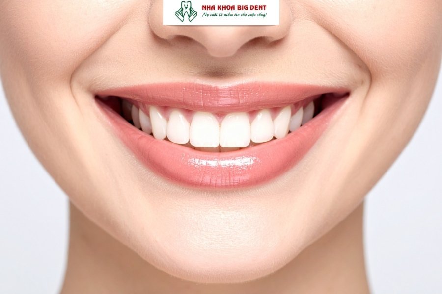 niềng răng có được vĩnh viễn không