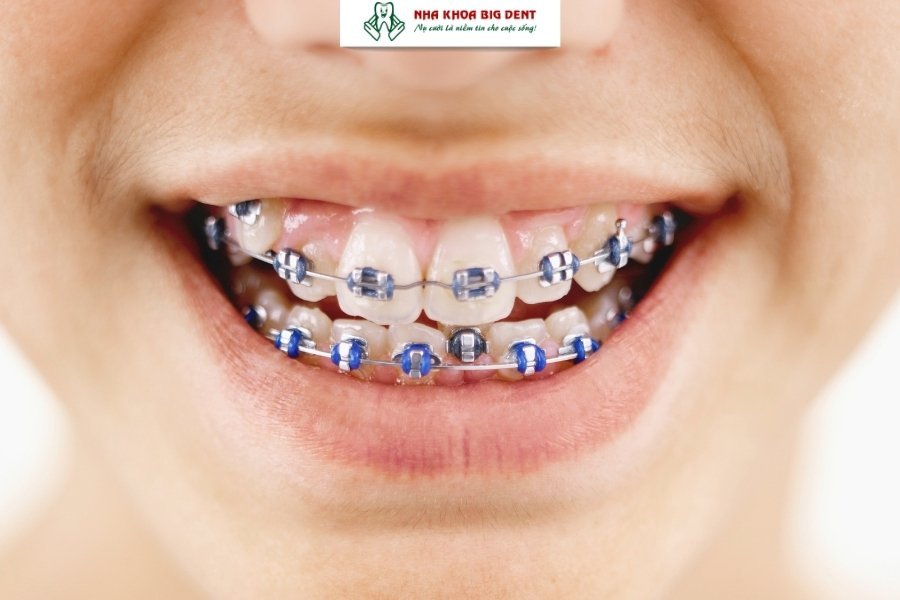niềng răng mắc cài kim loại