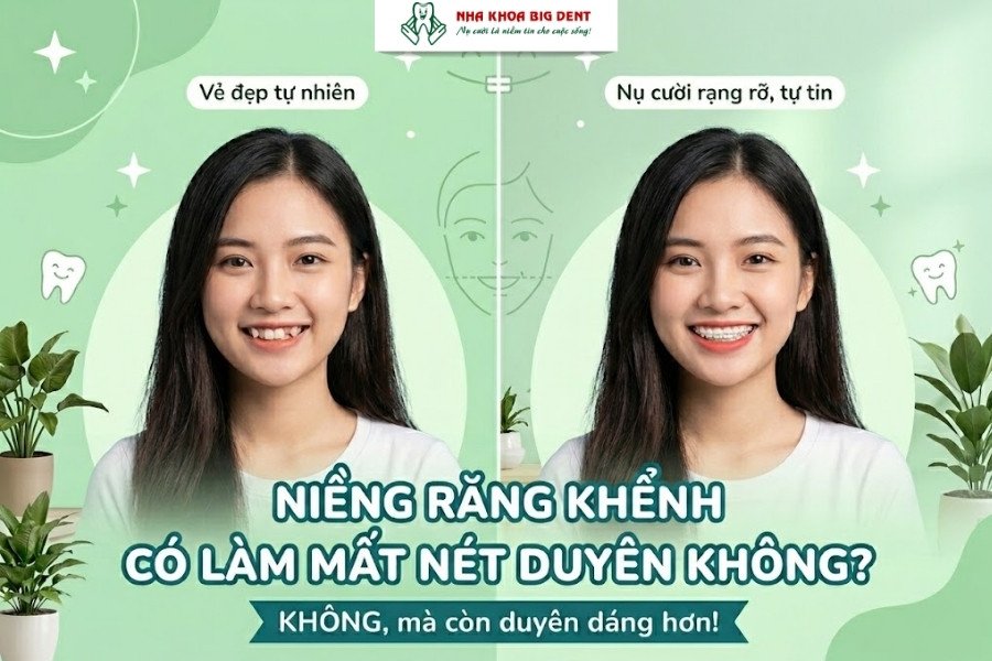 niềng răng khểnh