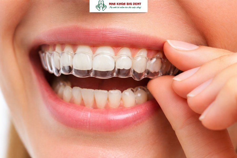 niềng răng trong suốt