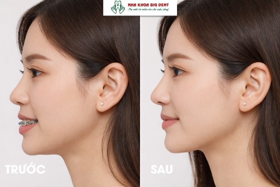 niềng răng có làm mũi cao hơn không