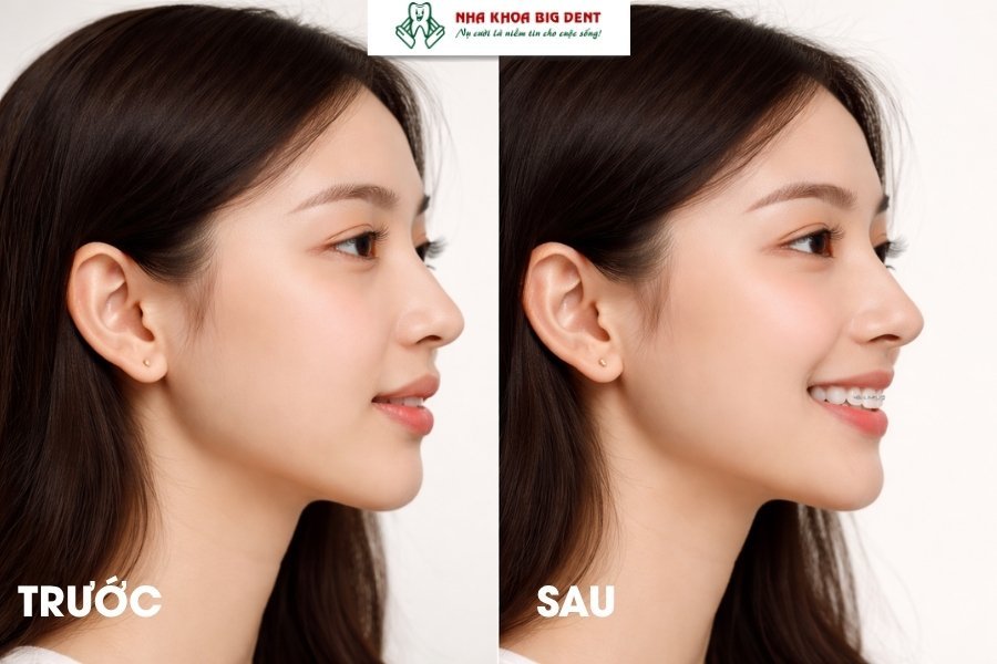 niềng răng có làm mũi cao hơn không