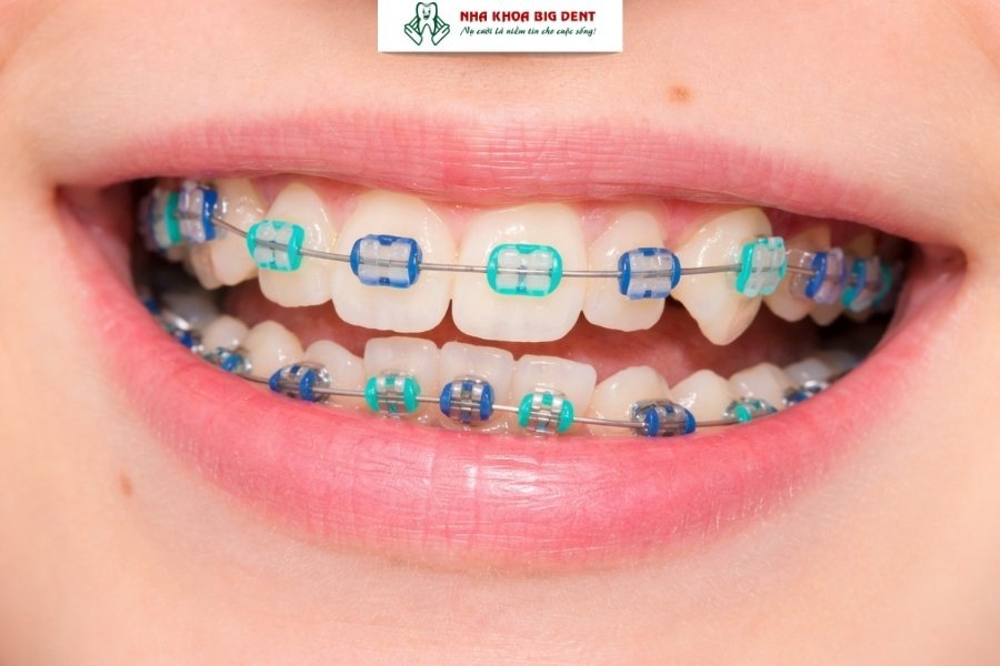 Niềng răng mắc cài sứ