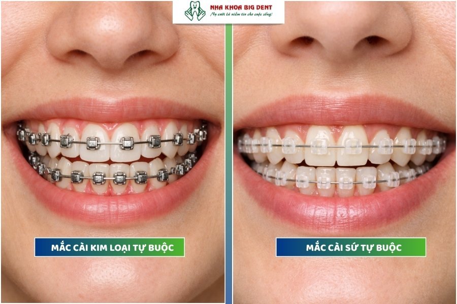 Niềng răng mắc cài tự buộc