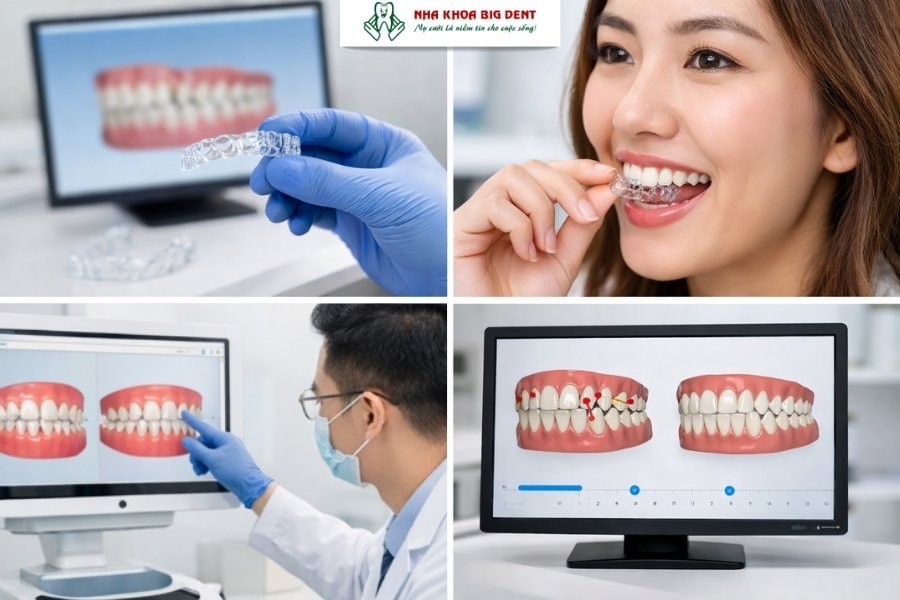 niềng răng tháo lắp