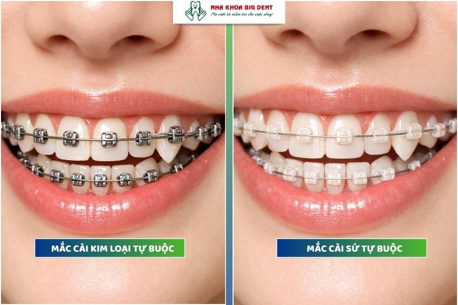 niềng răng khểnh