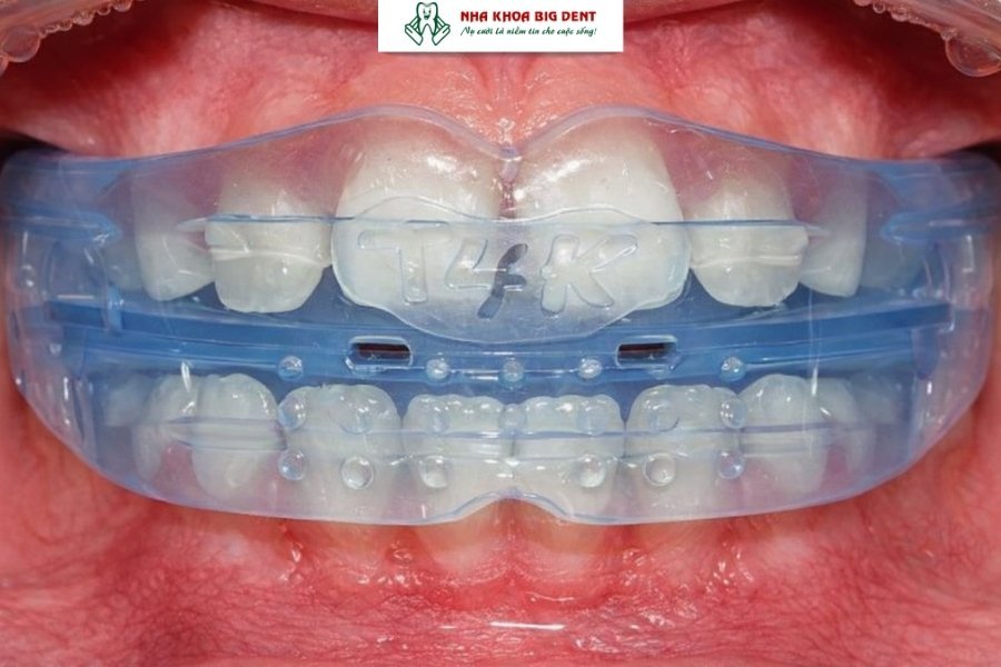niềng răng silicon