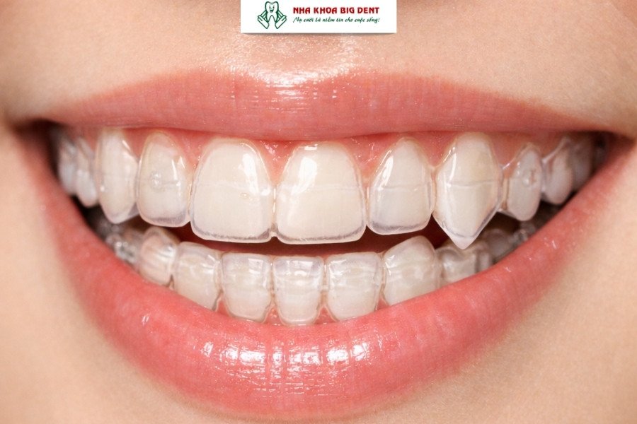 niềng răng khểnh