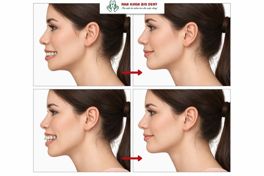 cằm lẹm niềng răng