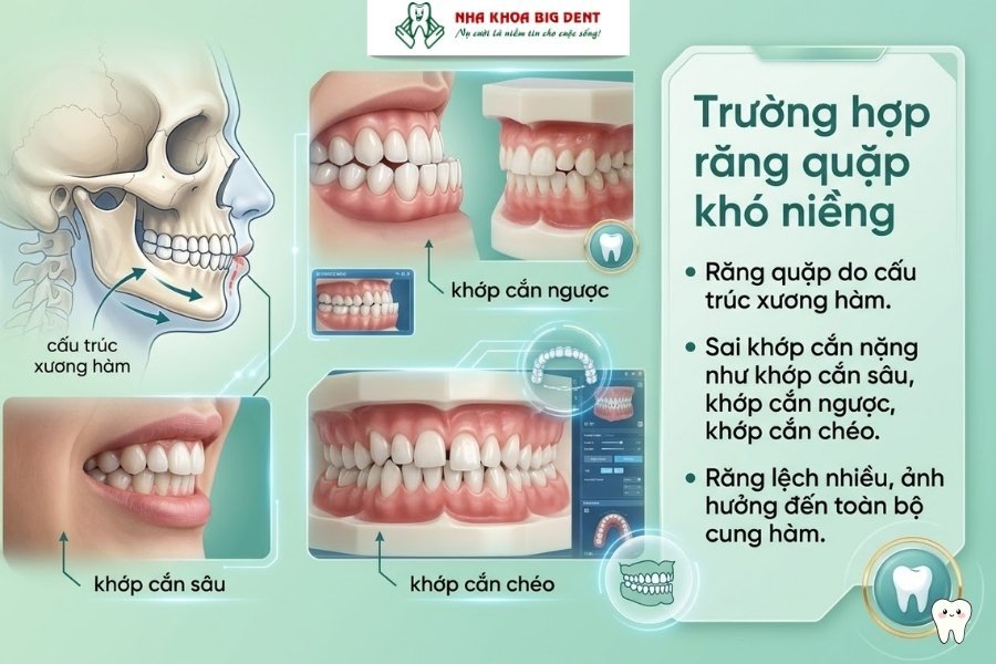 răng quặp có niềng được không