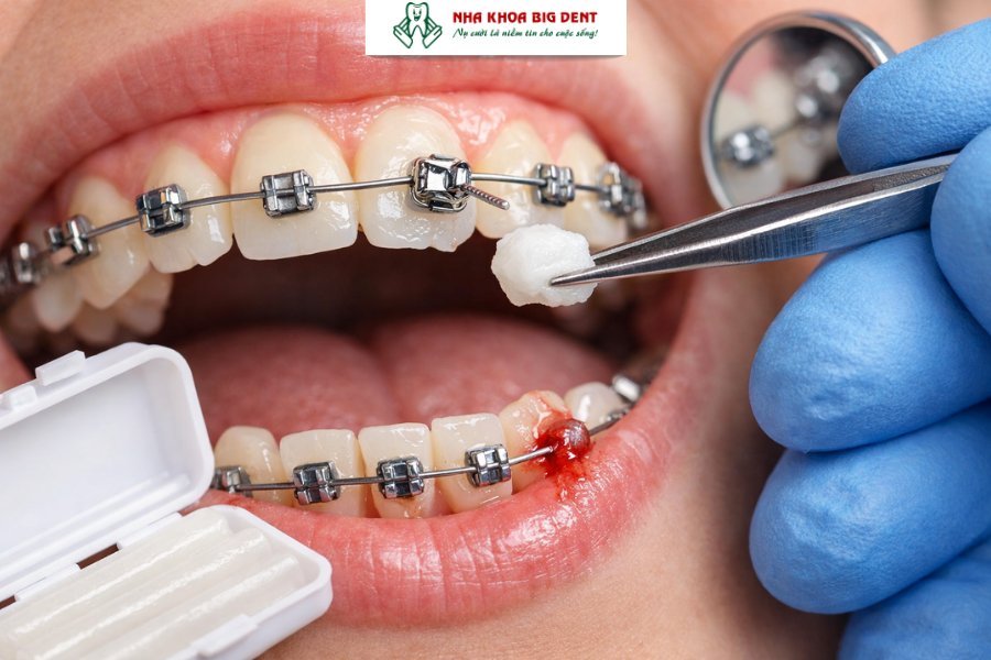 niềng răng có chơi thể thao được không