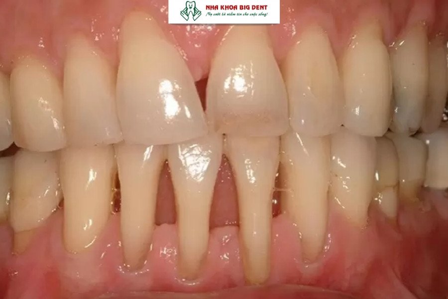 tác hại của niềng răng