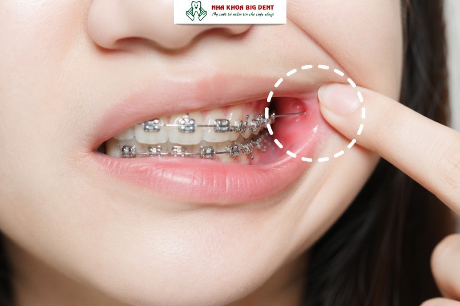 những dấu hiệu khi mới niềng răng