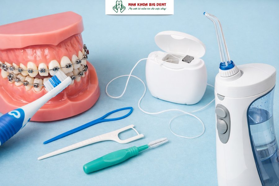 những điều cần biết trước khi niềng răng