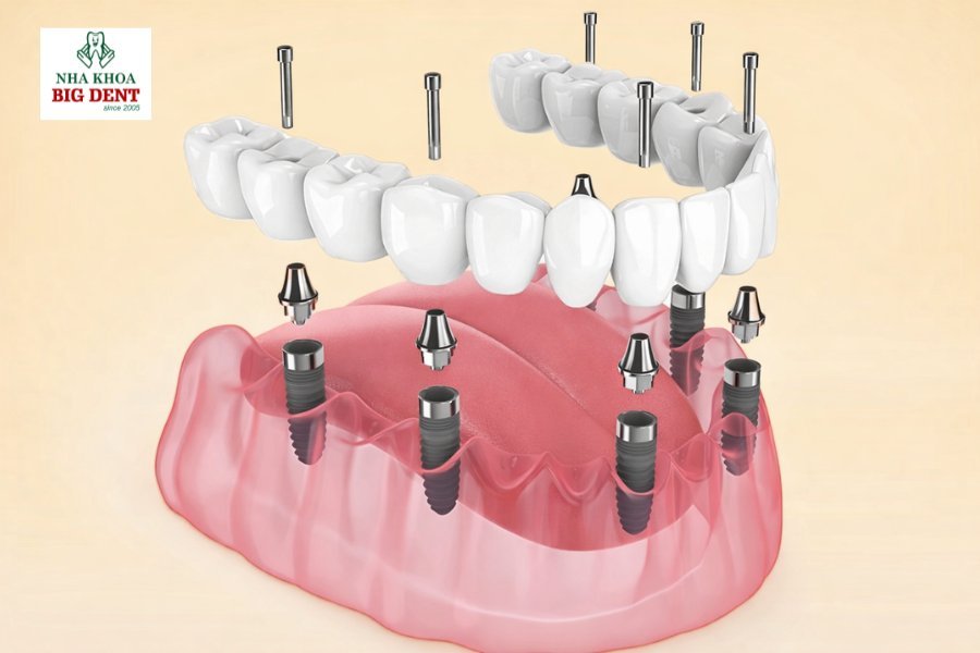 trường hợp không nên niềng răng