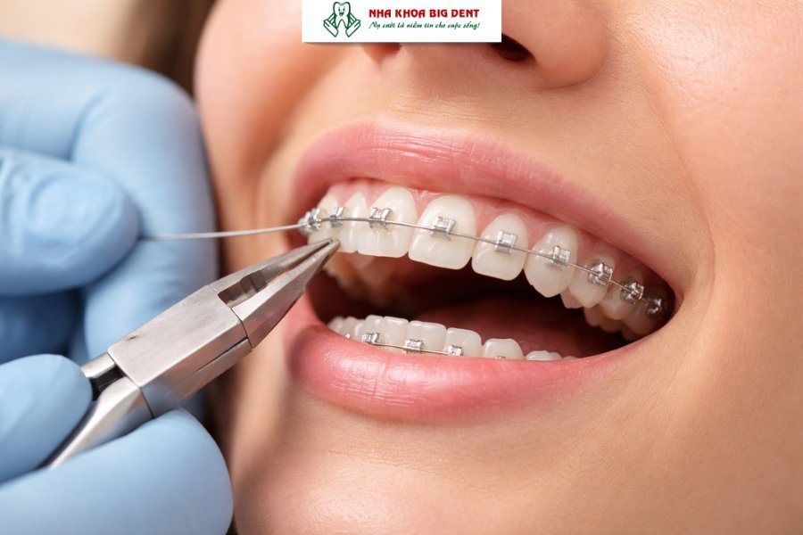 niềng răng có uống bia được không