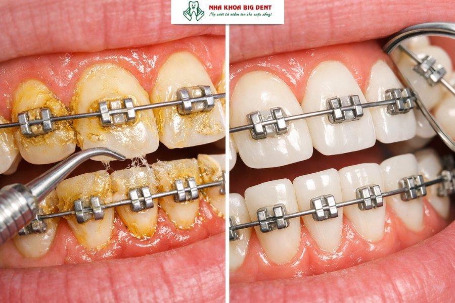 niềng răng có tẩy trắng răng được không