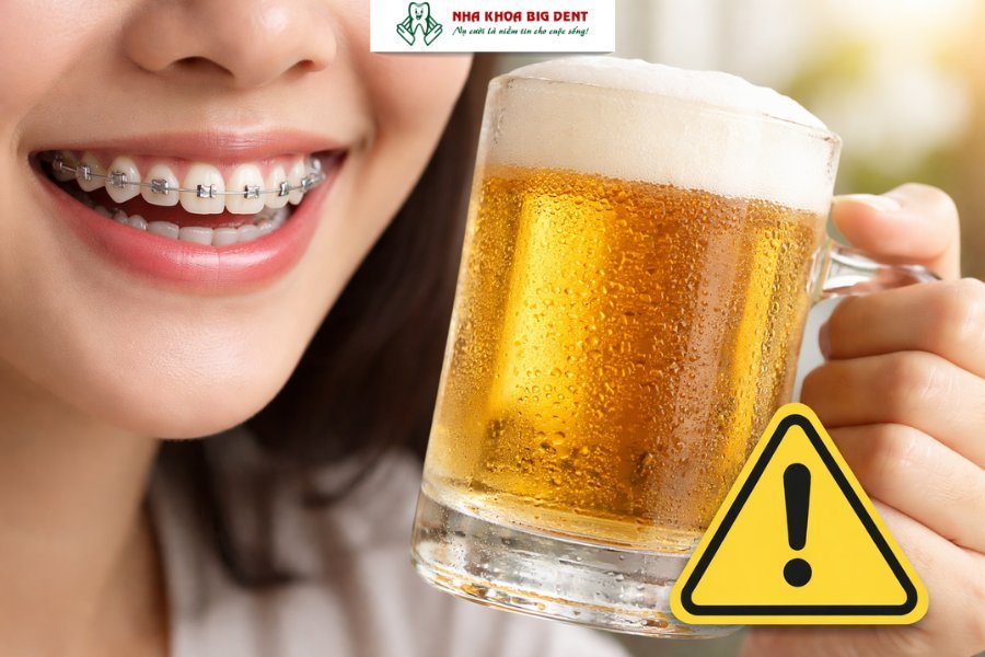niềng răng có uống bia được không