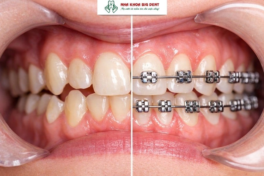 niềng răng có làm răng dài ra không