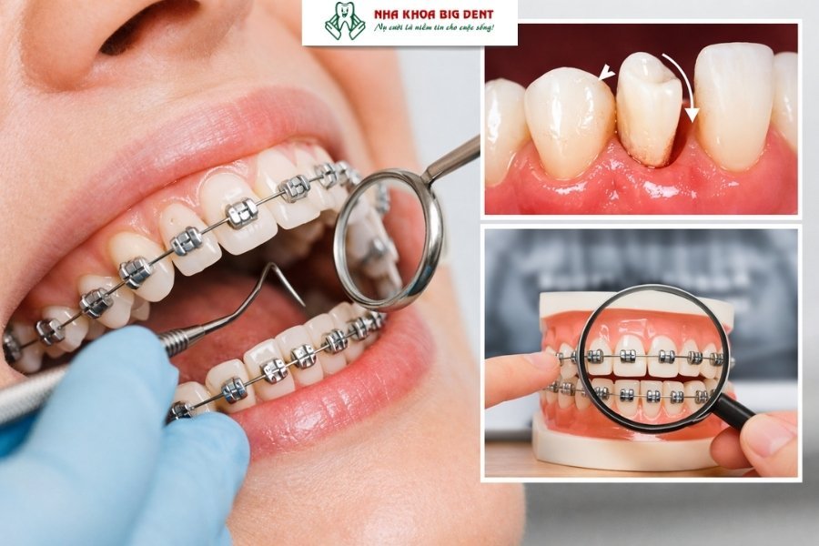 niềng răng có bị rụng răng không