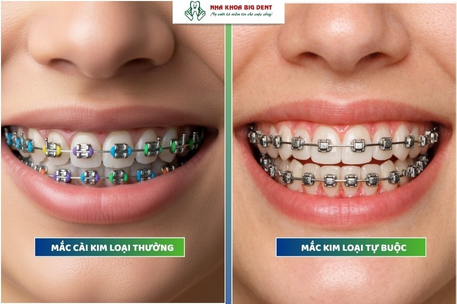 niềng răng mắc cài kim loại