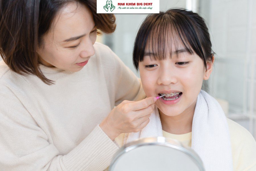 lưu ý khi niềng răng cho trẻ