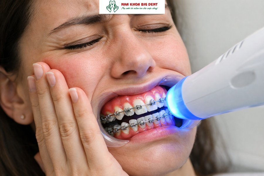 niềng răng có tẩy trắng răng được không