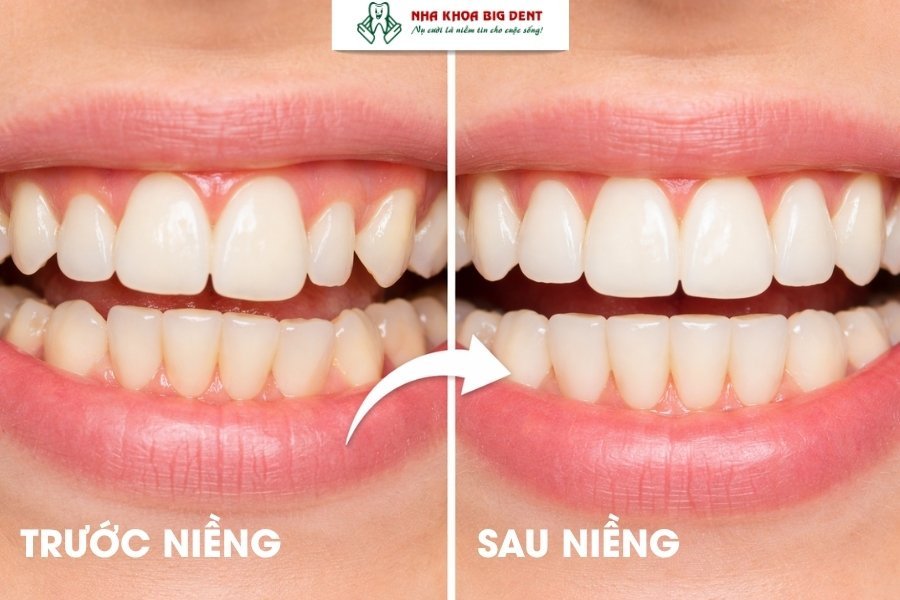 niềng răng có làm răng dài ra không