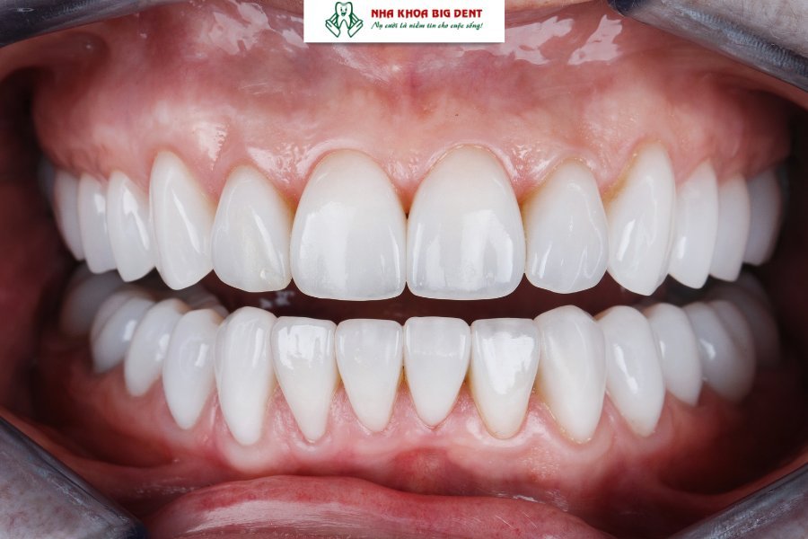 trường hợp không nên niềng răng