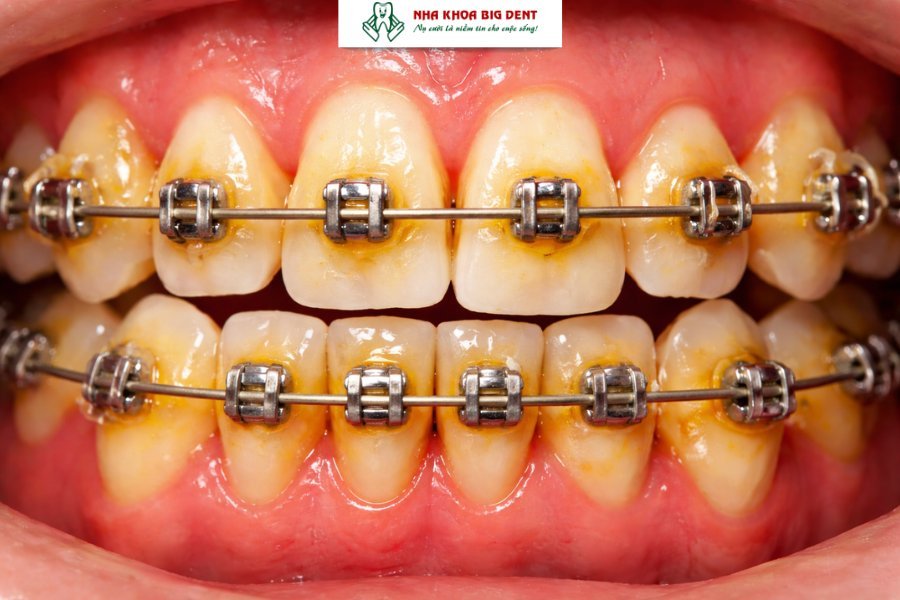 niềng răng có uống bia được không