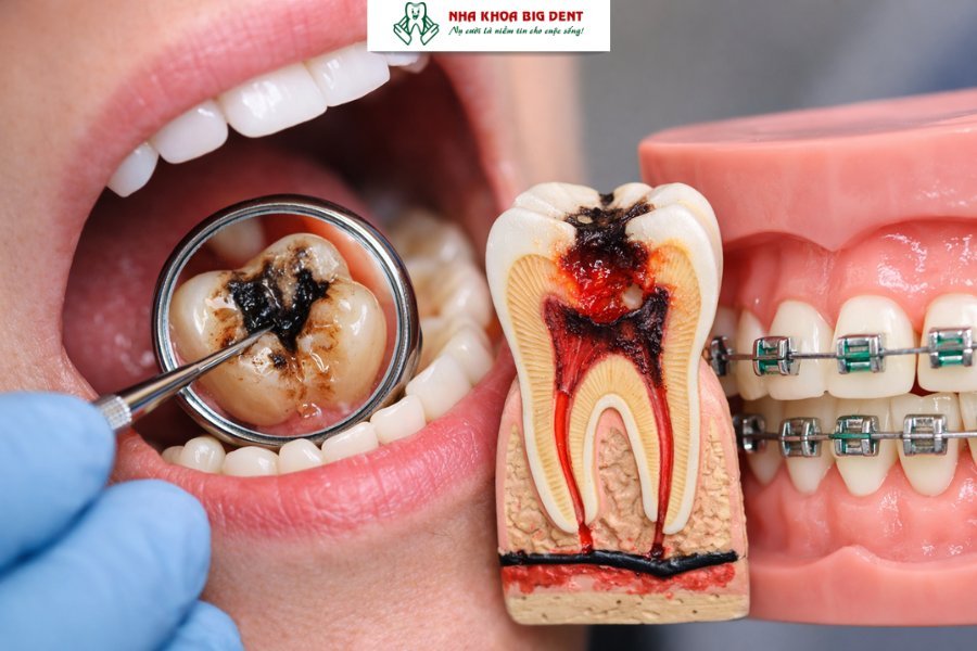 trường hợp không nên niềng răng