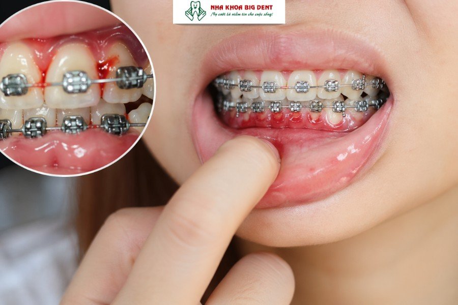 những dấu hiệu khi mới niềng răng